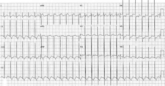 Read more about the article ECG Case 324