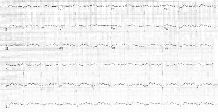 Read more about the article ECG Case 325