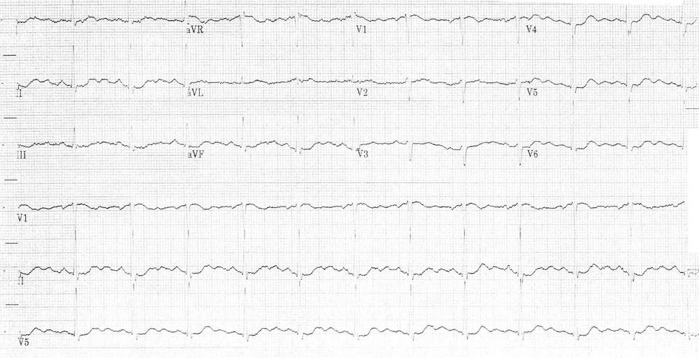 ECG of a 66-year-old female who presented to the ED complaining of dizziness and pre-syncope