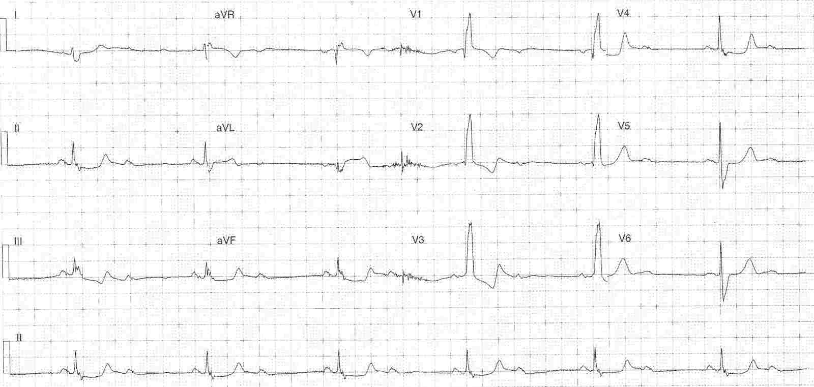 Read more about the article ECG Case 326