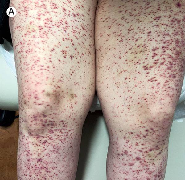 Case of Scurvy - Manual of Medicine