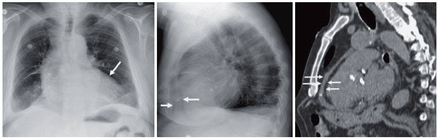 Frontal and Lateral chest x-ray, and CT showing Pericardial Effusion with Fat Pad (Sandwich) Sign