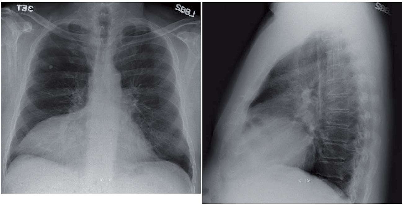 Read more about the article 55-year-old Man With Chest Discomfort