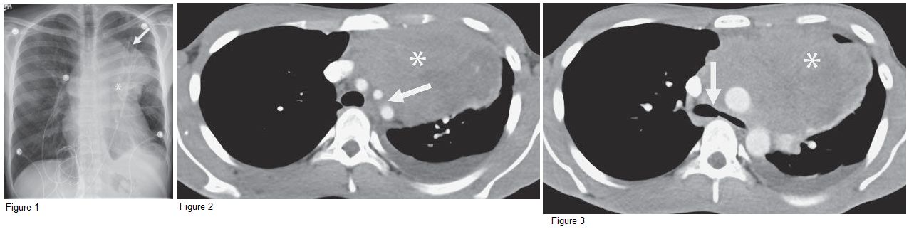CXR and chest CT showing Anterior Mediastinal Mass (Diffuse Large B-cell Lymphoma)