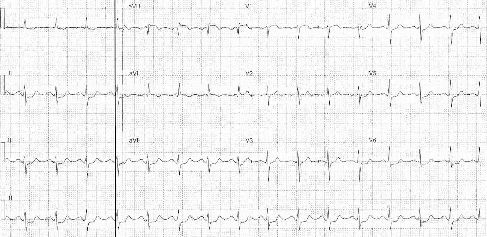 ECG during episode of chest pain