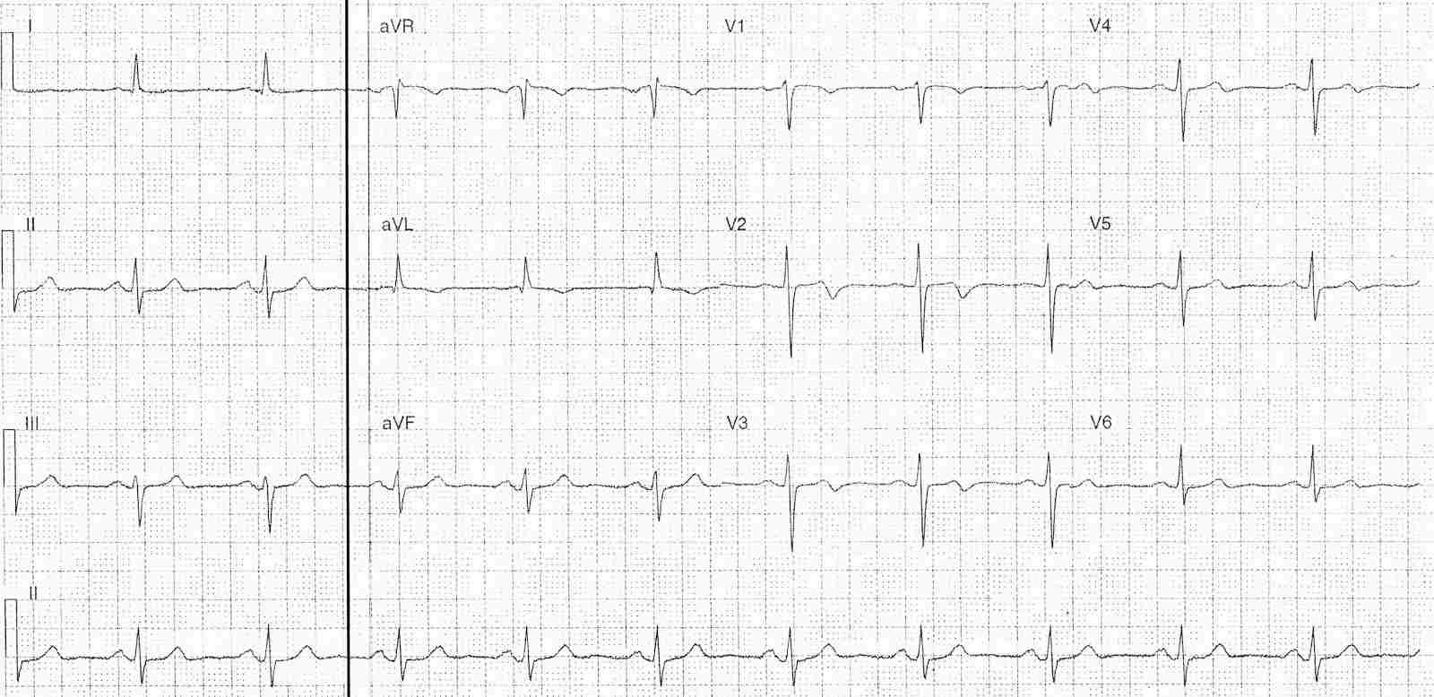 ECG on presentation, pain free
