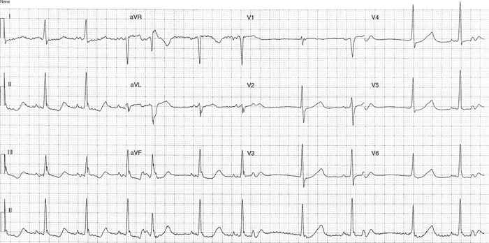 Read more about the article ECG Case 329