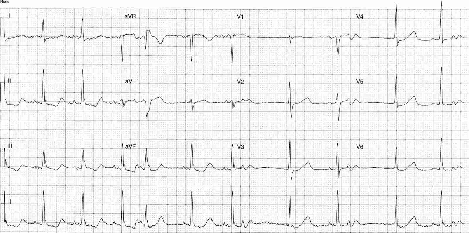 ECG of a 52-year-old female with confusion and abnormal biochemistry results