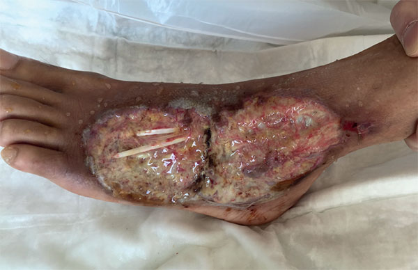 Read more about the article Ulcerative Colitis and Non-Healing Wound