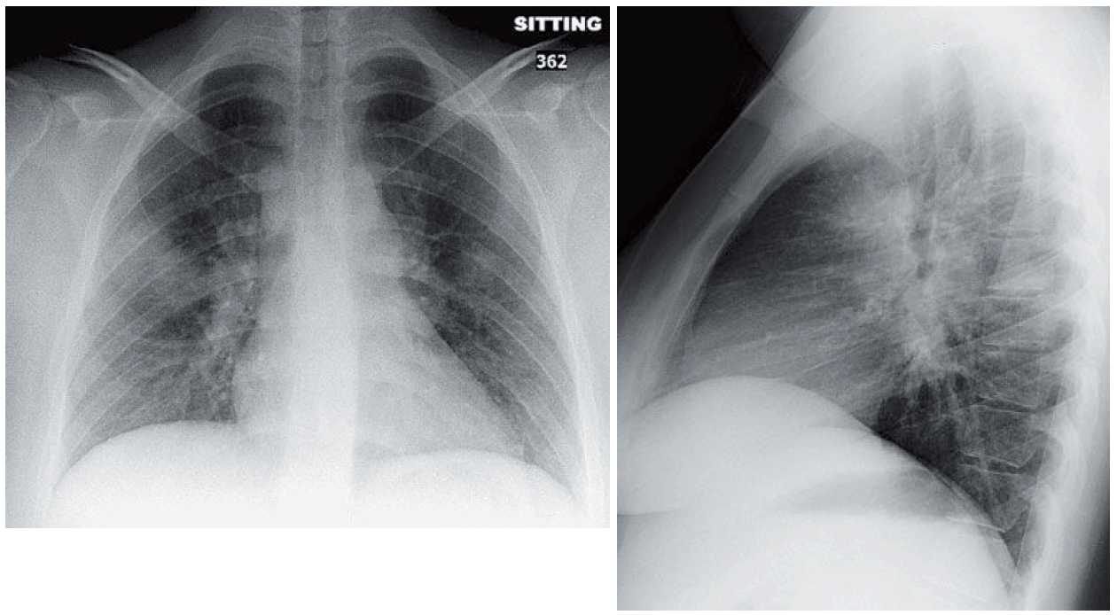 Read more about the article 35-year-old with Chest Pain and Shortness of Breath