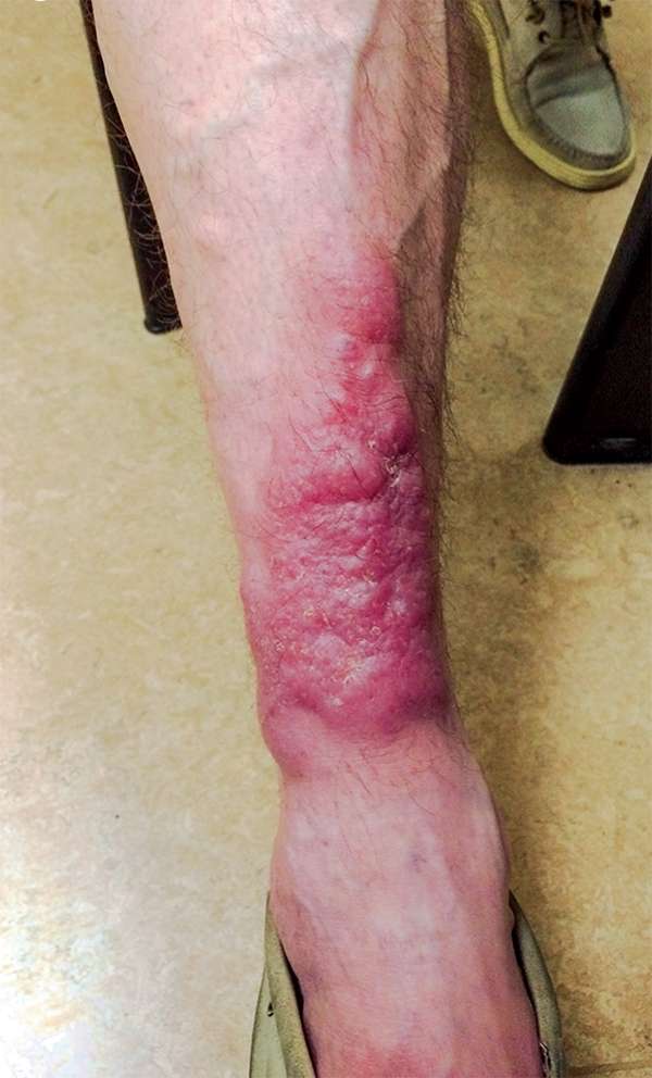 Read more about the article Bilateral, Nodular, Plaques on Shins