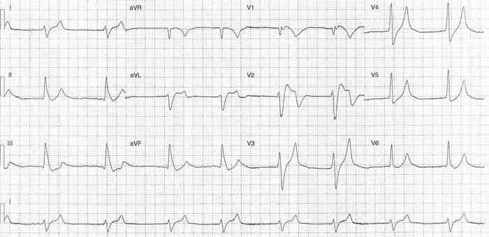 Read more about the article ECG Case 332