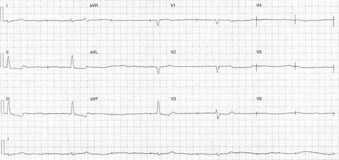 Read more about the article ECG Case 333