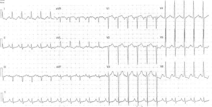 Read more about the article ECG Case 334