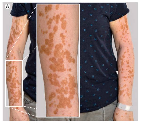 Read more about the article Skin Lesions with a Leopard-Like Appearance