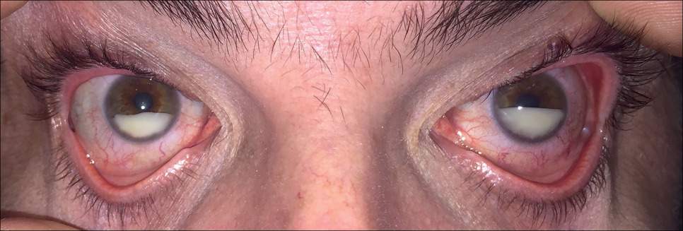 Pseudohypopyon Caused by Lymphoma