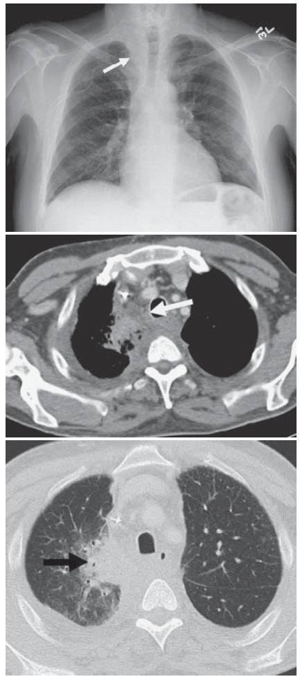 CXR and CT showing Acute Mediastinitis