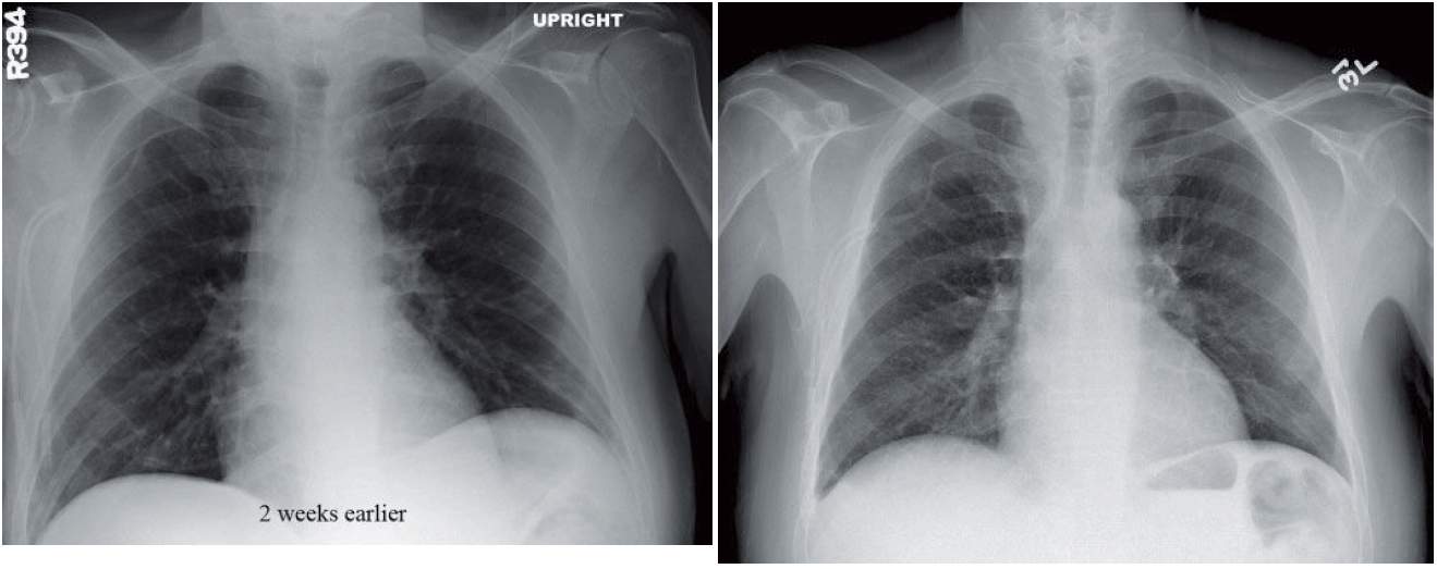 Read more about the article Chest Pain in a Patient with History of Bone Marrow Transplant
