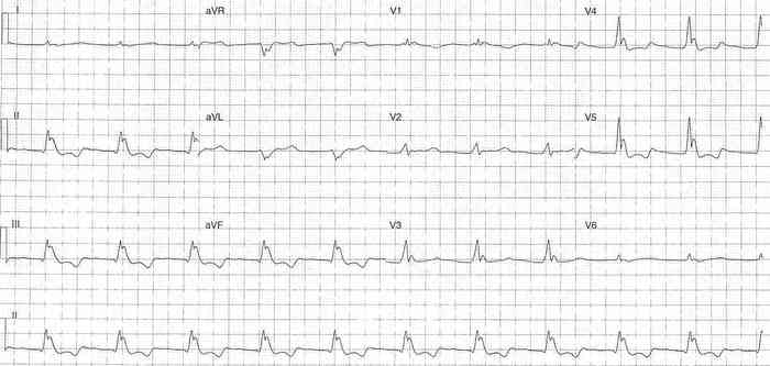 Read more about the article ECG Case 335