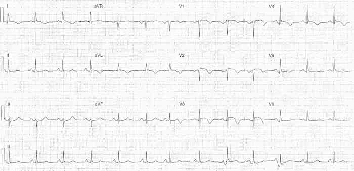 Read more about the article ECG Case 336