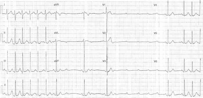 Read more about the article ECG Case 337