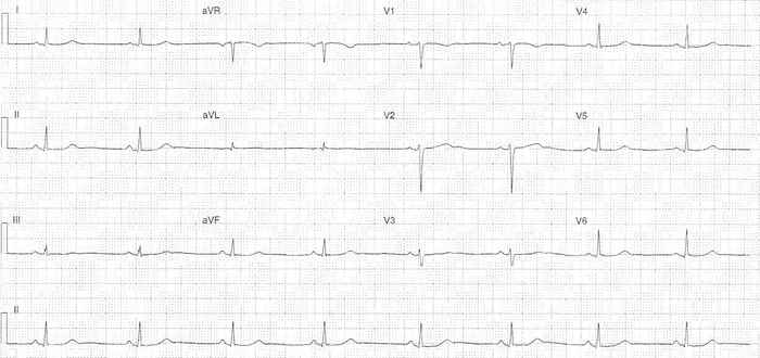 Read more about the article ECG Case 338