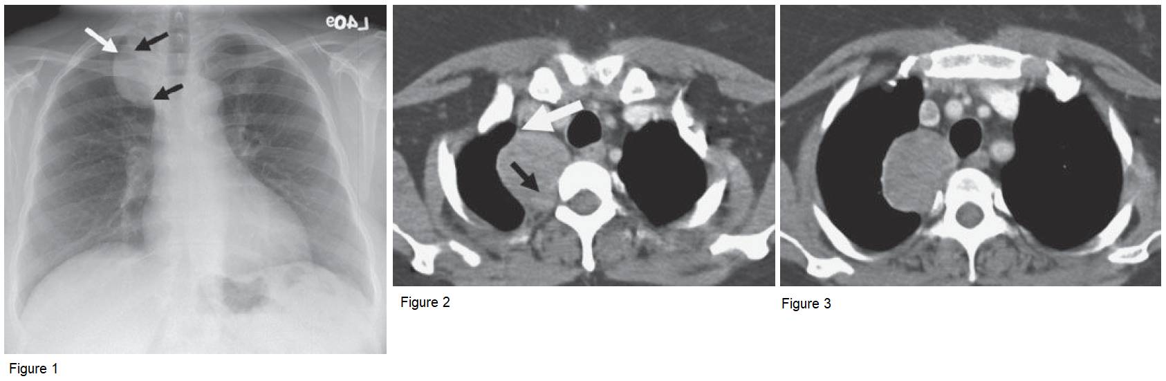 Chest x-ray and chest CT showing Posterior Mediastinal Mass (Schwannoma)