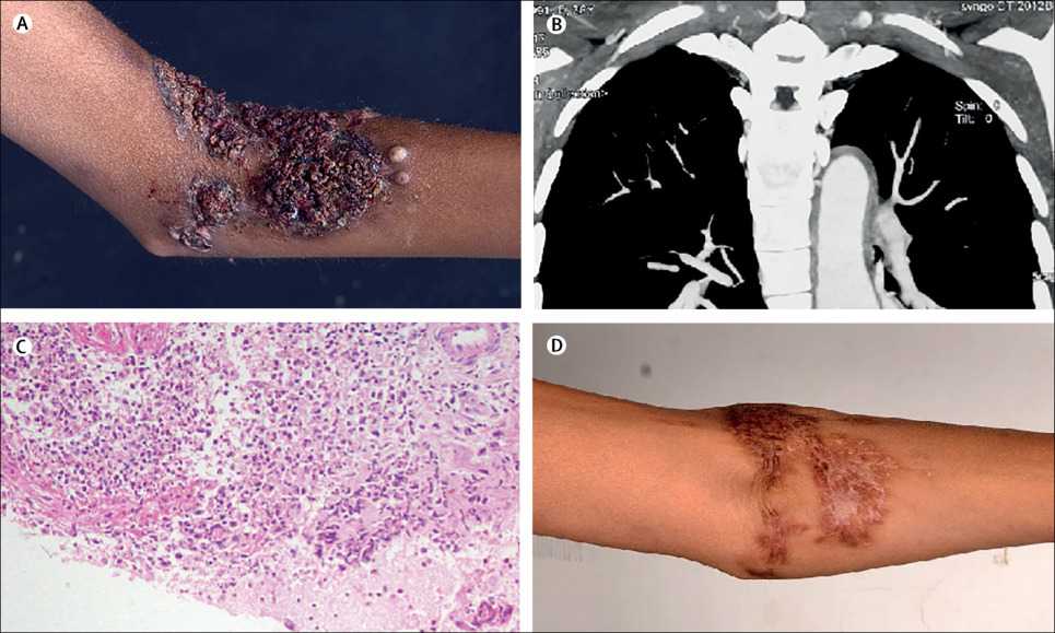 Read more about the article Recurrent Superficial Thrombophlebitis, DVT, and Non-Healing Ulcer