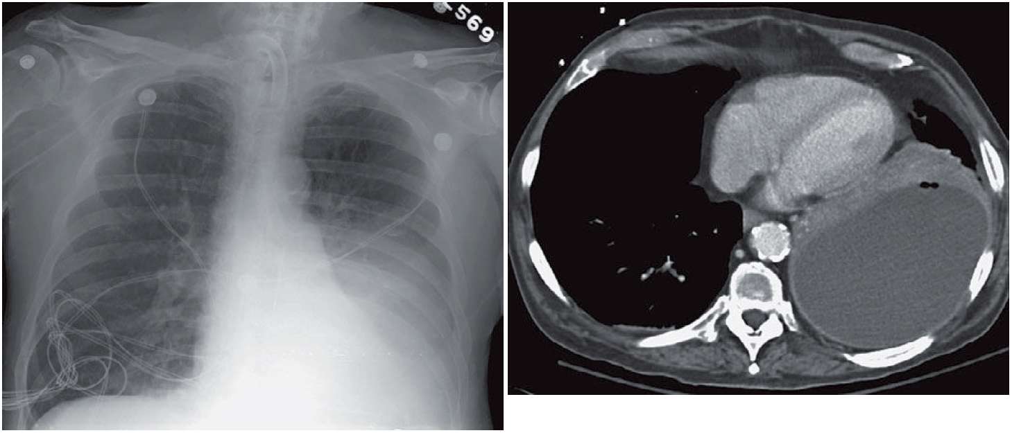 Read more about the article 73-year-old Patient with Pneumonia