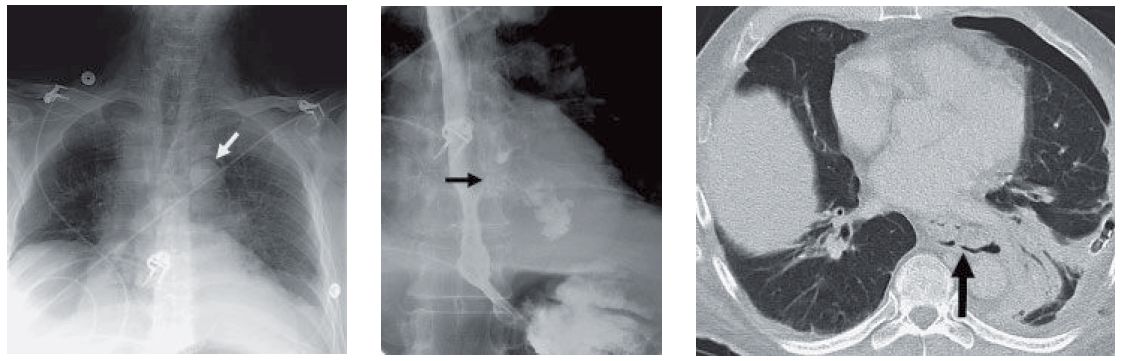 CXR and CT showing of Esophageal Perforation