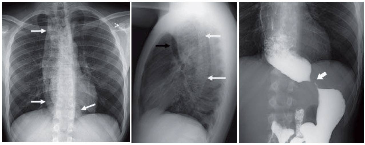 Case of Achalasia