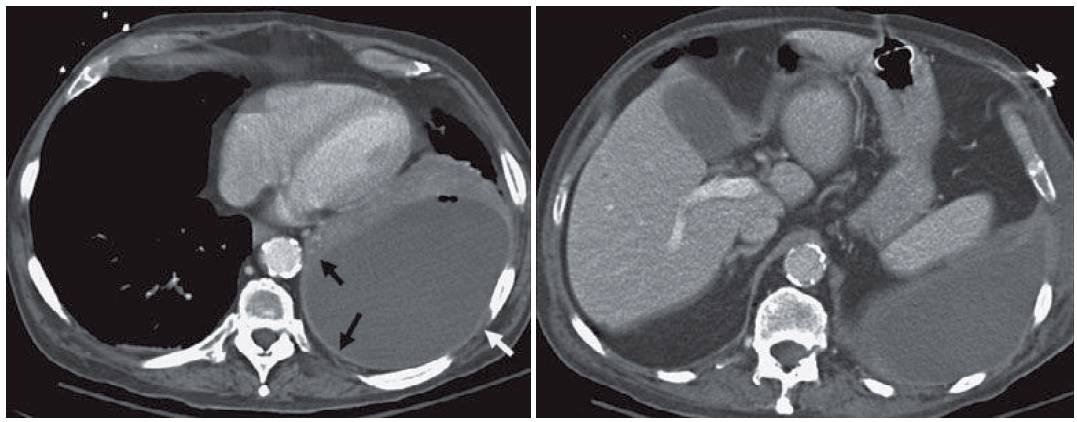 Chest CT showing Empyema