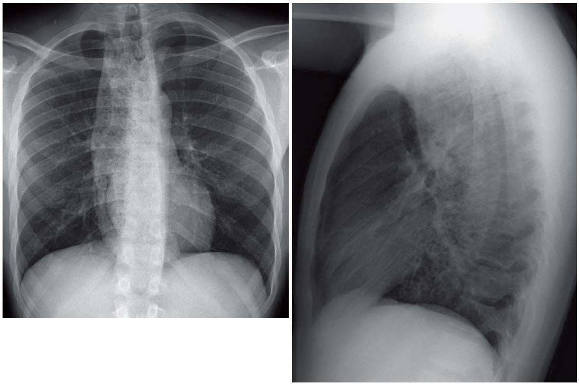 Read more about the article Chest Pressure After Eating