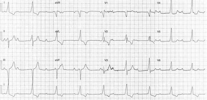 Read more about the article ECG Case 339