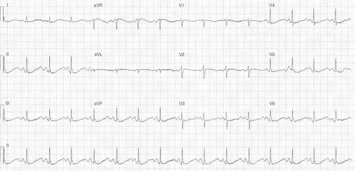 Read more about the article ECG Case 341