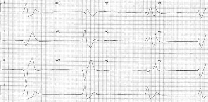 Read more about the article ECG Case 342