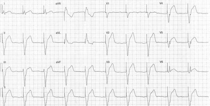 Read more about the article ECG Case 343