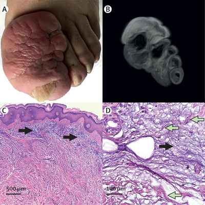 Read more about the article Growing Mass on the Big Toe