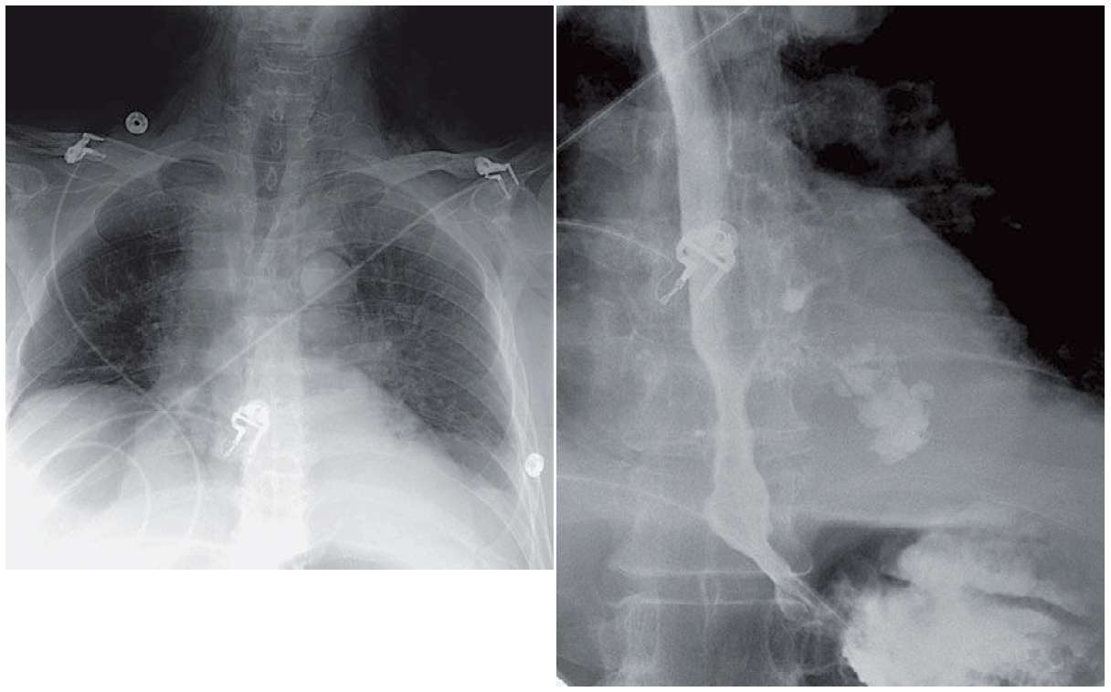 Read more about the article Patient with Acute Respiratory Failure and Sepsis