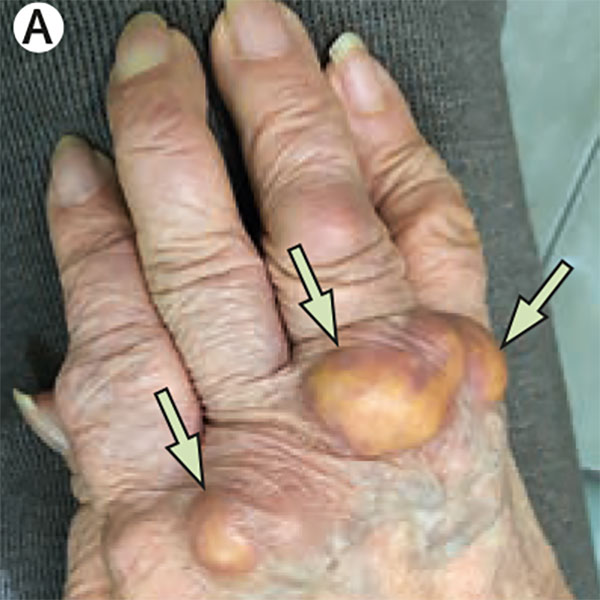 Read more about the article Polyarthralgia and Painless Subcutaneous Nodules