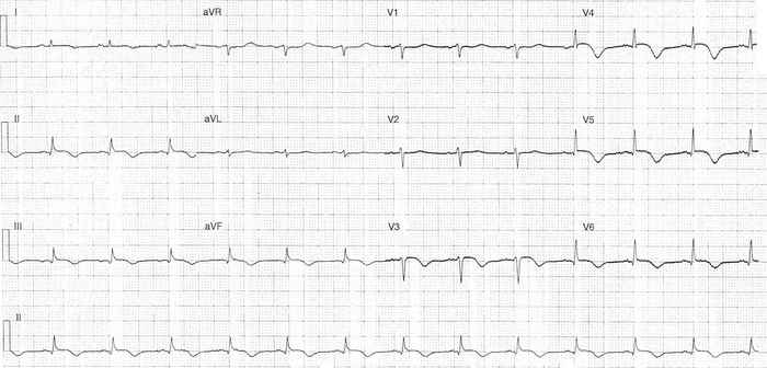 Read more about the article ECG Case 345