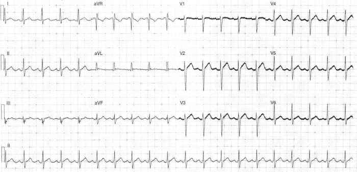 Read more about the article ECG Case 346