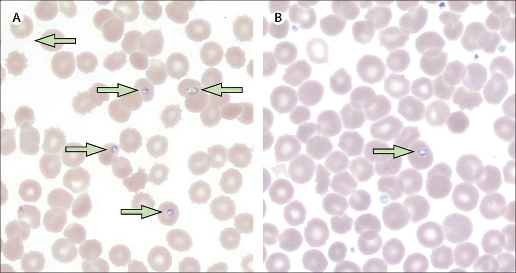 Read more about the article Fever, Haemolysis, and Thrombocytopenia in Pregnancy