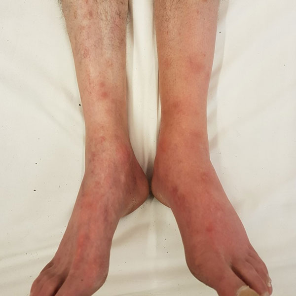 Read more about the article Inflammatory leg nodules