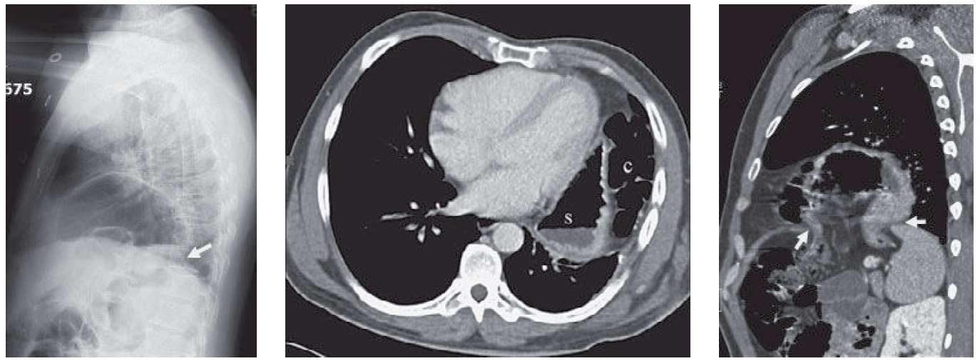 CXR and CT showing Ruptured Diaphragm