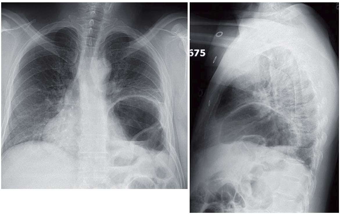 Read more about the article Shortness of Breath After Falling Out of a Tree
