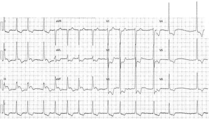 Read more about the article ECG Case 348