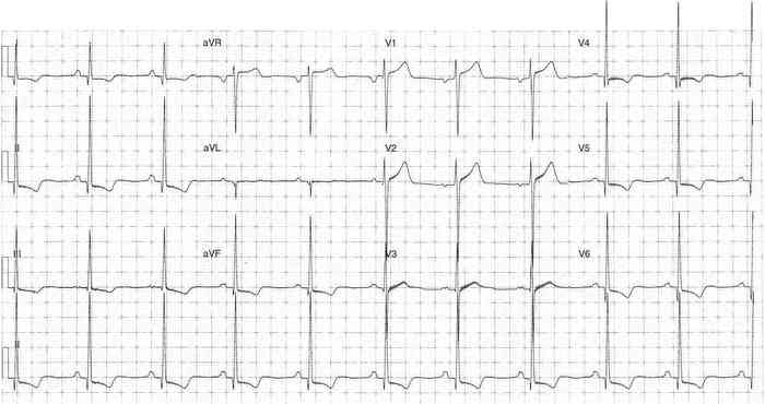 Read more about the article ECG Case 350