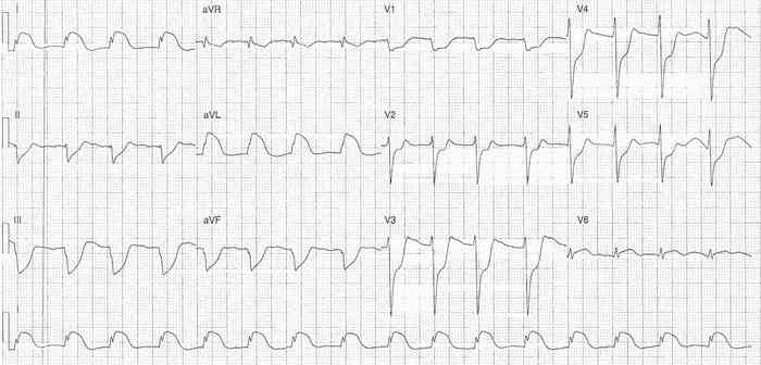 Read more about the article ECG Case 351